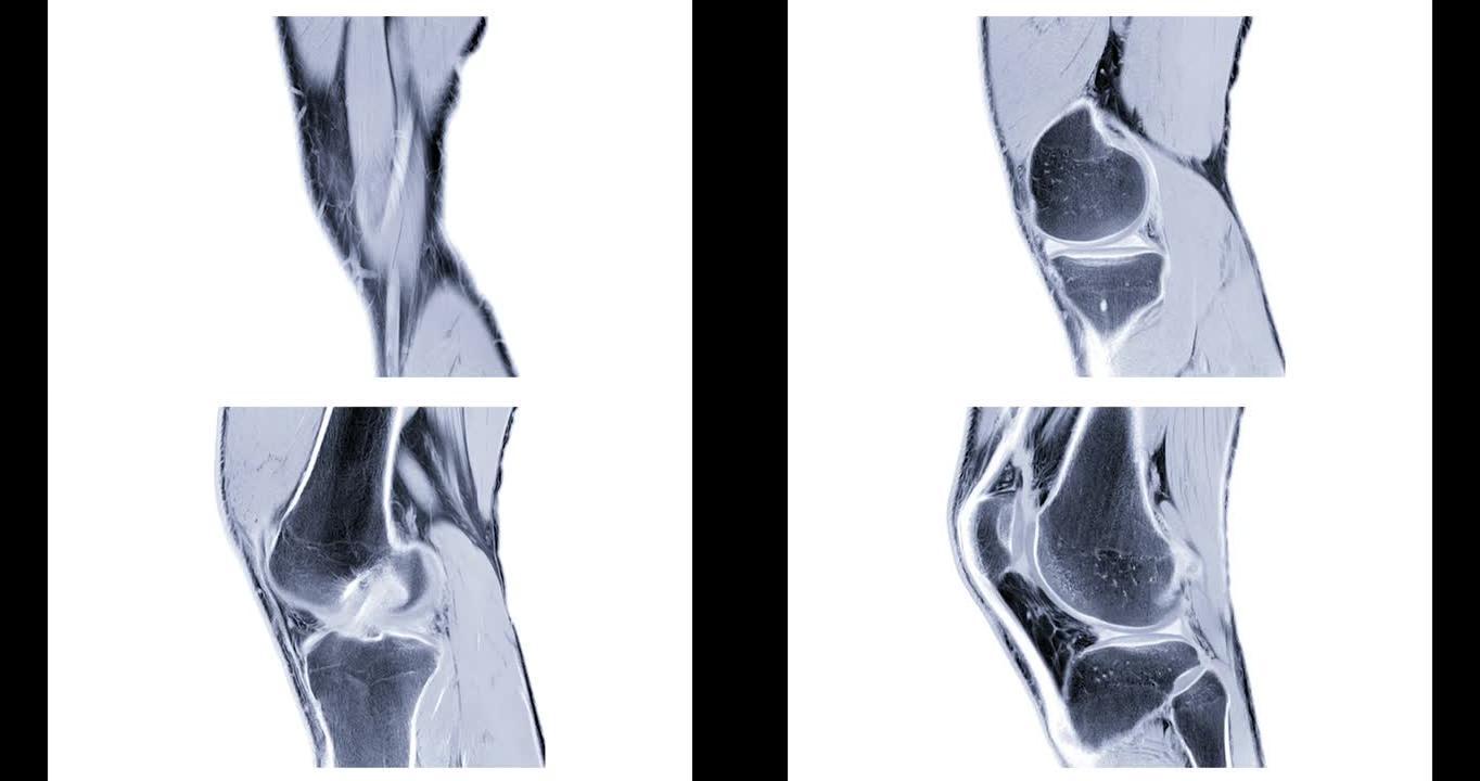 MRI膝关节或磁共振成像膝关节矢状位，用于诊断前交叉韧带 (ACL) 撕裂。