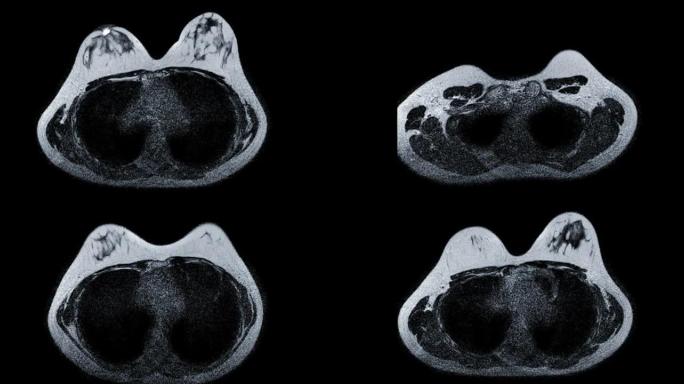 乳腺癌筛查女性乳腺MRI或磁共振成像。
