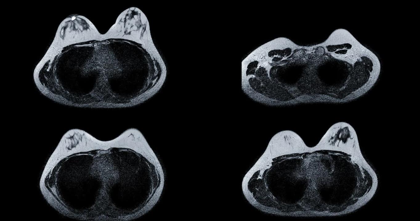 乳腺癌筛查女性乳腺MRI或磁共振成像。