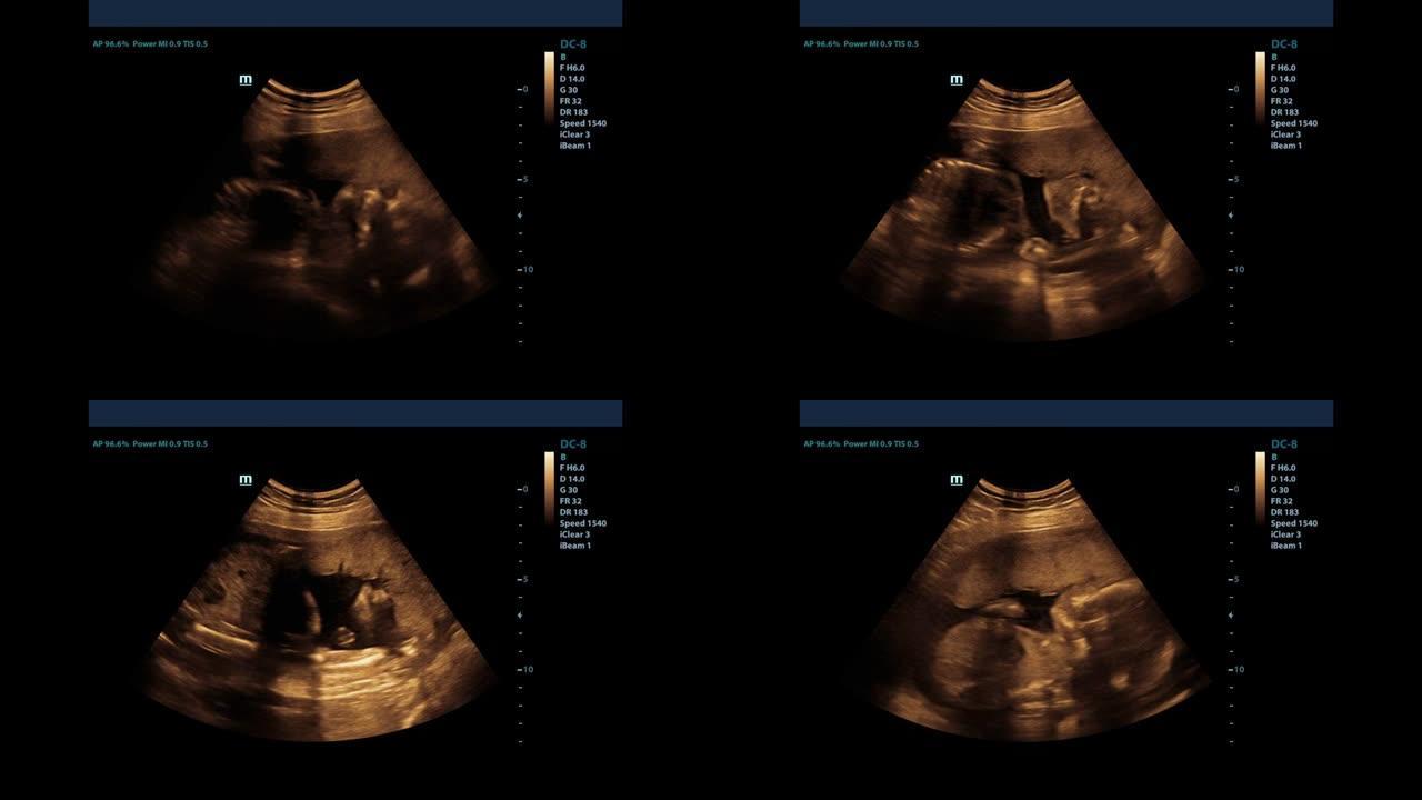 检查记录一名孕妇使用超声波，这表明婴儿在移动。超声波扫描期间婴儿移动。怀孕概念