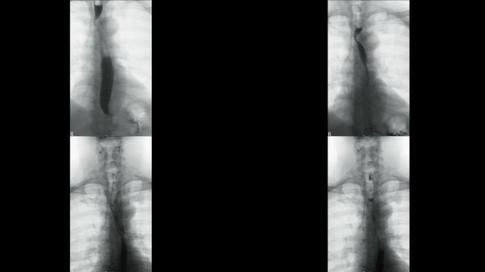 在荧光镜控制下吞咽钡，显示食管解剖结构以诊断吞咽困难。