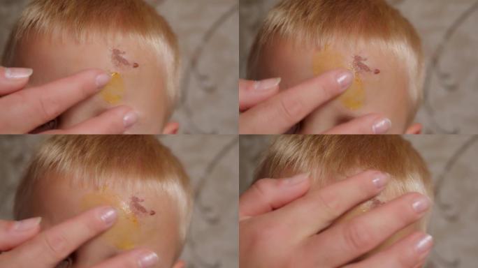一位慈爱的母亲将药膏涂在儿子额头上的擦伤和肿块上。