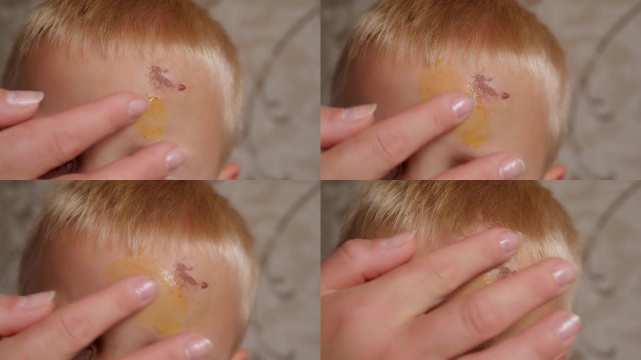一位慈爱的母亲将药膏涂在儿子额头上的擦伤和肿块上。