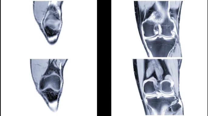 MRI膝关节或膝关节冠状面磁共振成像。