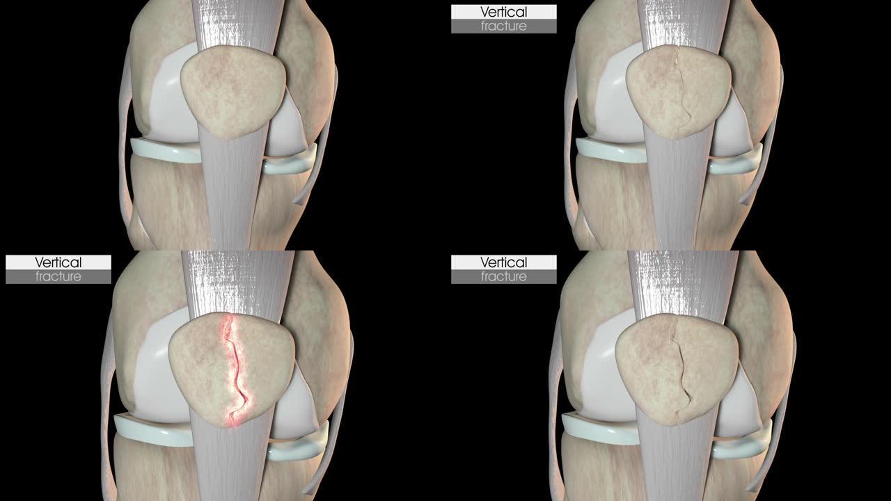 髌骨垂直骨折