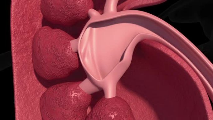肾结石内脏脏器模拟演示动画全息影像