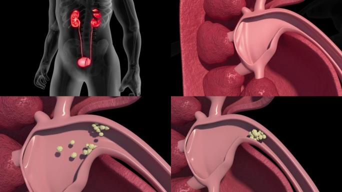 肾结石内脏脏器模拟演示动画全息影像