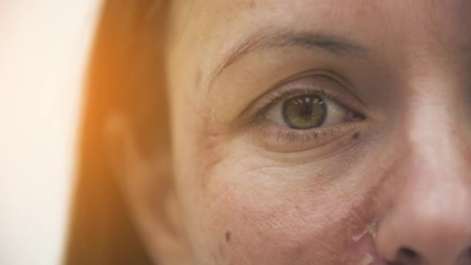 4k慢动作女性眼睛和受损皮肤的裁剪视频。