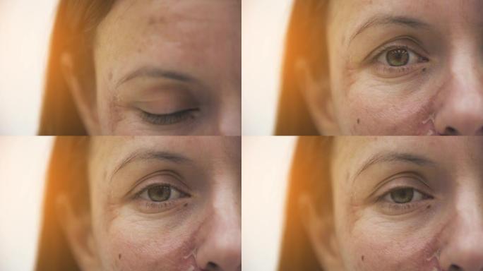 4k慢动作女性眼睛和受损皮肤的裁剪视频。