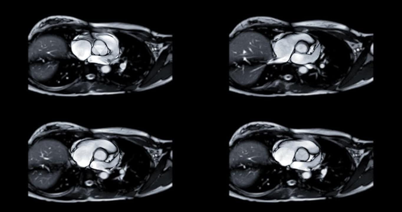 MRI心脏或心脏MRI (磁共振成像) 显示主动脉瓣以检测心脏病。