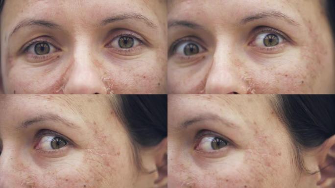 4k慢动作特写女性面部皮肤问题视频。