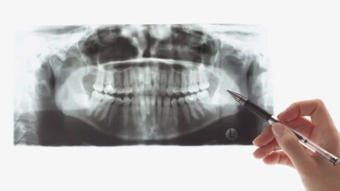 手指向牙科扫描的问题区域。臼齿位置异常。医生在光屏或阴性镜背景下检查x射线