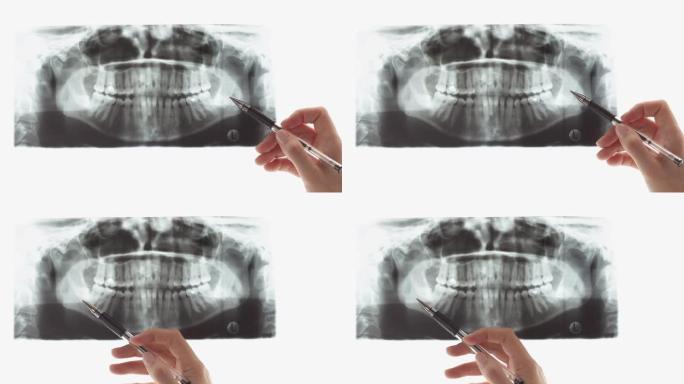 手指向牙科扫描的问题区域。臼齿位置异常。医生在光屏或阴性镜背景下检查x射线