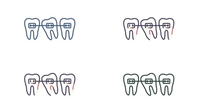 正畸矫正器矫正牙齿。牙齿排列的阶段。运动图形。
