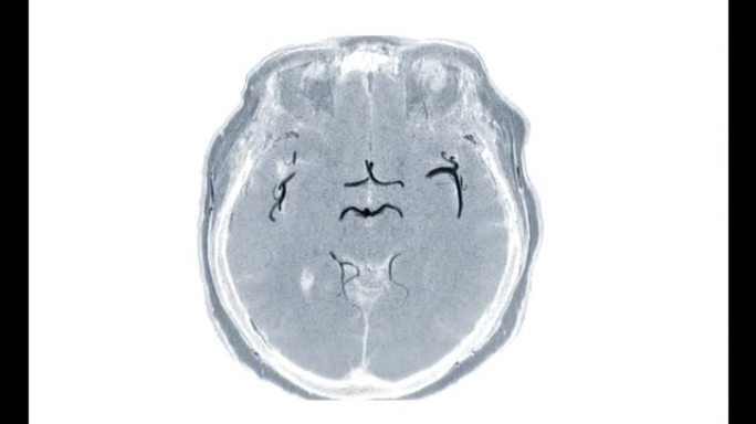 MRA脑或磁共振血管造影的脑轴向MIP TOF技术视图显示白色背景上的脑动脉。