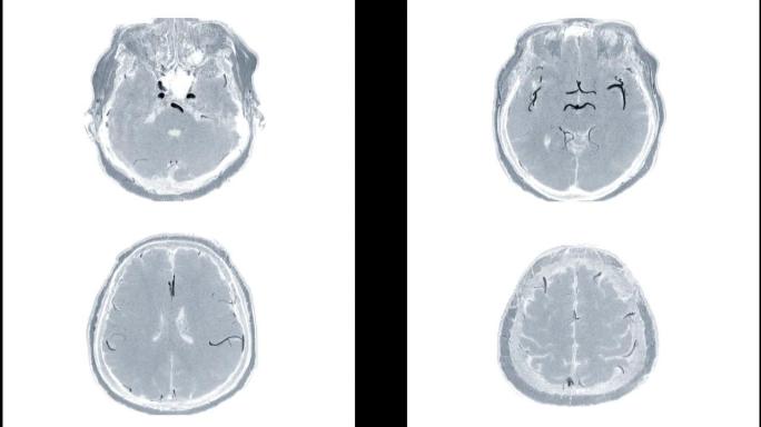 MRA脑或磁共振血管造影的脑轴向MIP TOF技术视图显示白色背景上的脑动脉。