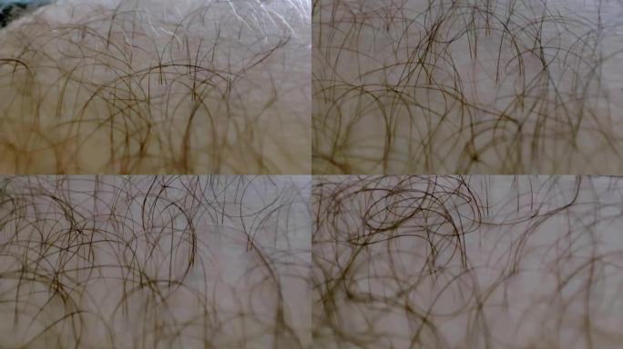 人类多毛皮肤的宏观。皮肤病学概念。头发过度生长