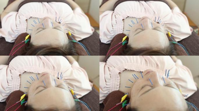 亚洲女性面部电针治疗
