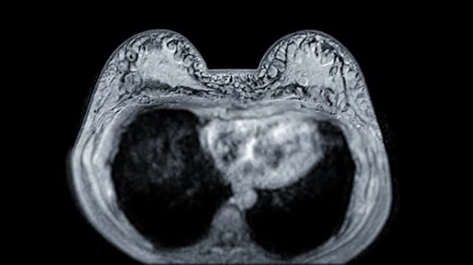 乳腺癌筛查女性乳腺MRI或磁共振成像轴向T1W。