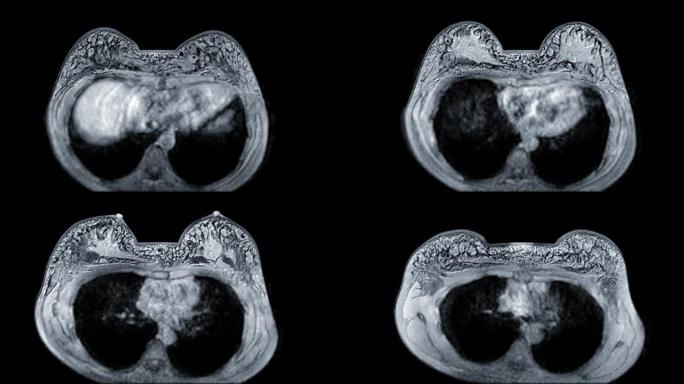乳腺癌筛查女性乳腺MRI或磁共振成像轴向T1W。