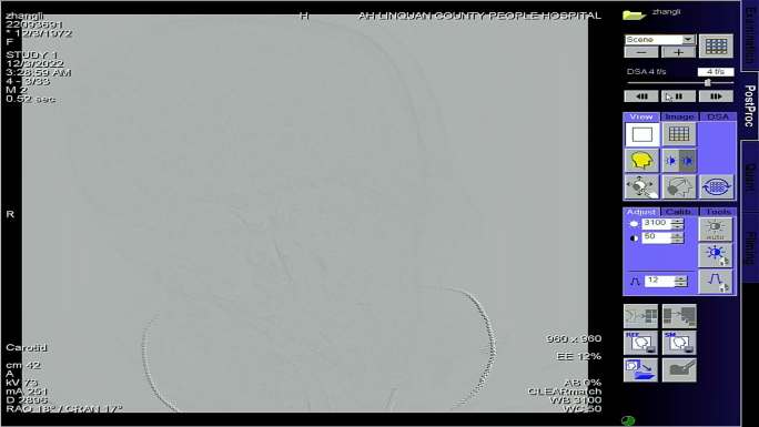 血管造影机脑梗脑血管卒中手术