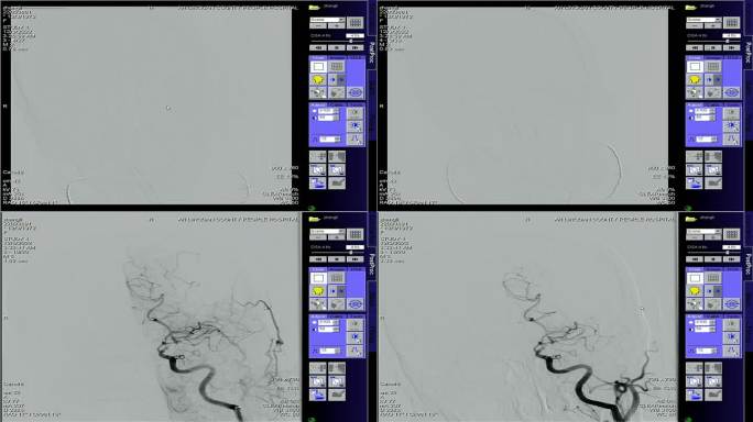 血管造影机脑梗脑血管卒中手术