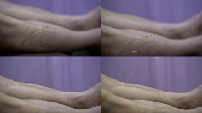 中国替代疗法针灸铜针对亚洲男子腿部康复调节体内阳气
