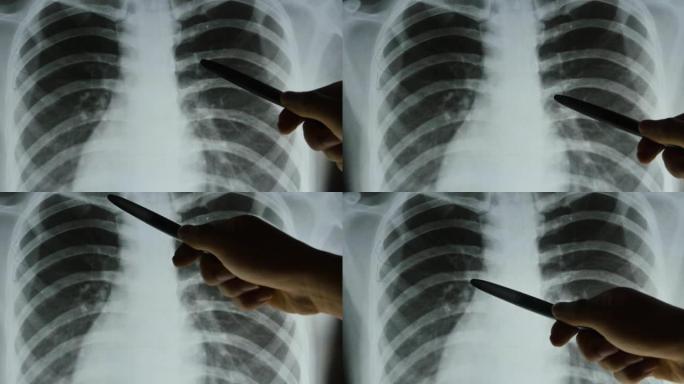 4k医生研究肺部x光片进行分析。医疗保健医院。