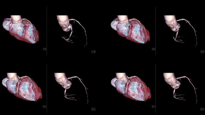 CTA冠状动脉3D渲染图像比较心脏3D和冠状动脉3D在屏幕上翻转以诊断血管冠状动脉狭窄。