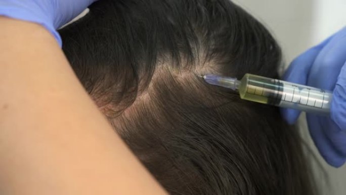 trichologist医生在女性的头部皮肤上进行注射以促进头发生长。