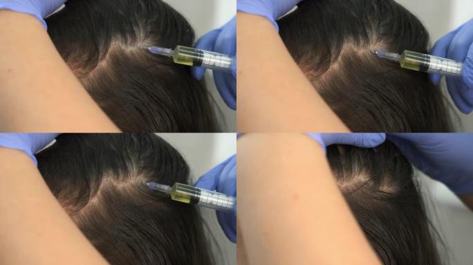 trichologist医生在女性的头部皮肤上进行注射以促进头发生长。