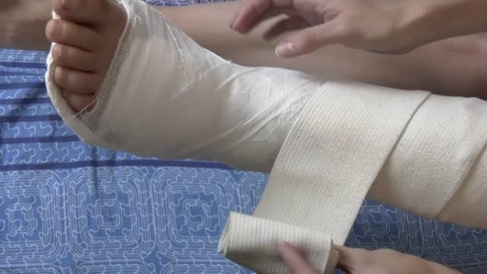 一个穿着石膏绷带坐在床上的女人从腿上取下了弹性绷带。腿部骨折，腿部骨折。25 FPS，缩小。