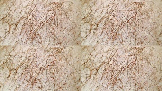 人类多毛皮肤的宏观。皮肤病学概念。头发过度生长