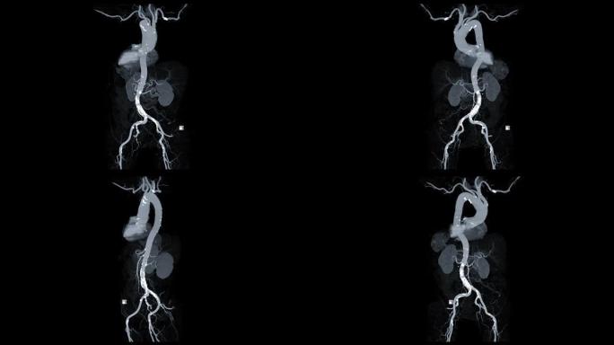 CTA全主动脉3D MIP在屏幕上转身诊断主动脉瘤。