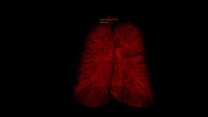 CT胸部或肺部3D渲染图像在屏幕上翻转以诊断结核病，结核病和新型冠状病毒肺炎。