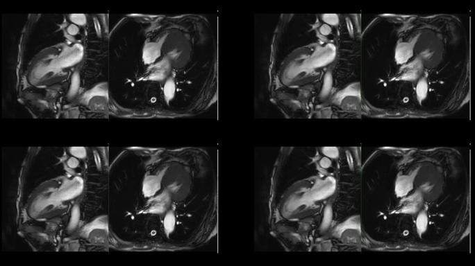 MRI心脏或心脏MRI (磁共振成像) 显示心脏跳动以检测心脏病。