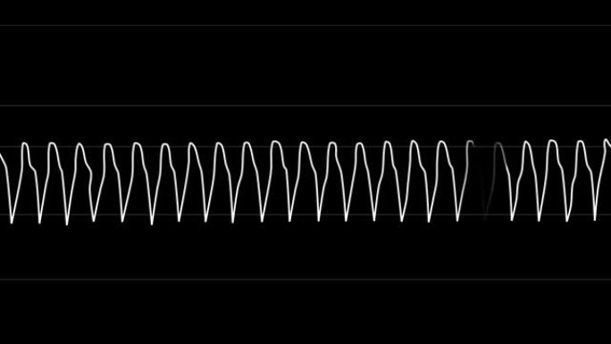 巴布亚新几内亚阿尔法。心电图循环。心率室性心动过速。类型5