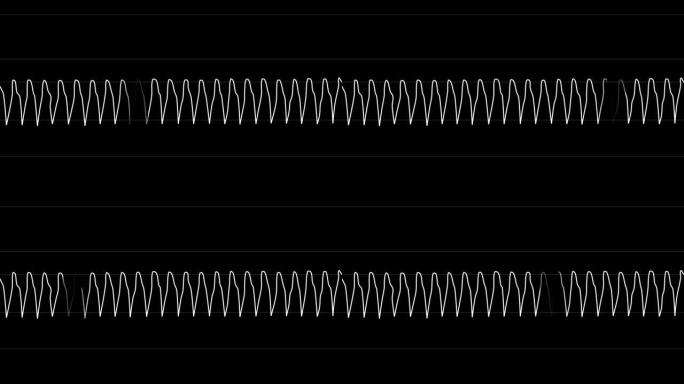 巴布亚新几内亚阿尔法。心电图循环。心率室性心动过速。类型5