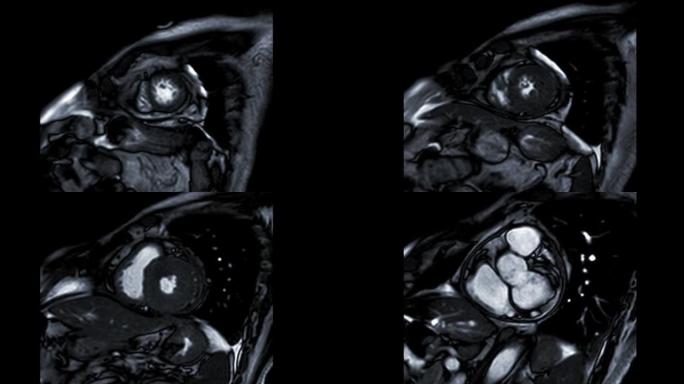 MRI心脏或心脏MRI (磁共振成像) 显示心脏跳动以检测心脏病。