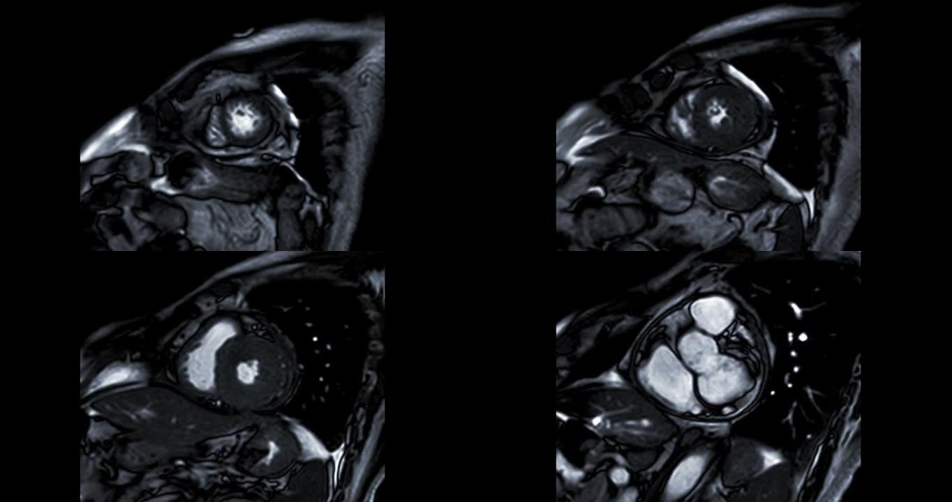 MRI心脏或心脏MRI (磁共振成像) 显示心脏跳动以检测心脏病。