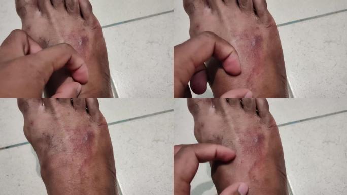 男子在近距离过敏和皮肤病时在脚底抓伤红疹