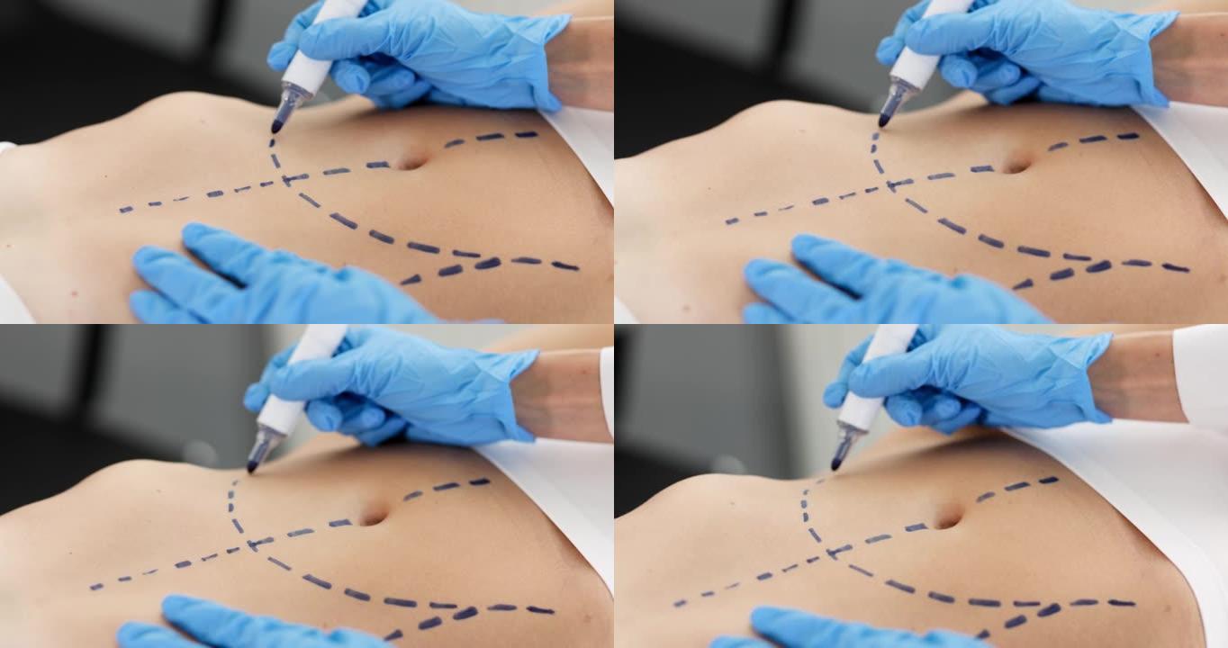 整形外科医生在患者腹部4k电影的皮肤上绘制术前标记