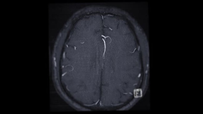 MRA脑或磁共振血管造影的脑轴向MIP视图显示脑动脉。