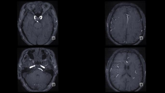 MRA脑或磁共振血管造影的脑轴向MIP视图显示脑动脉。