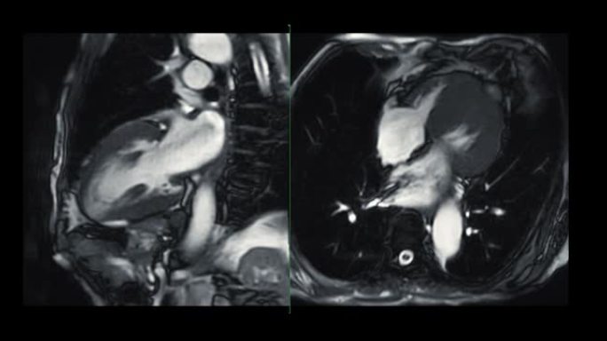 MRI心脏或心脏MRI (磁共振成像) 显示心脏跳动以检测心脏病。