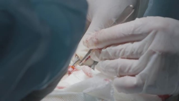 医生进行手术切除阑尾。行动。外科医生在麻醉下对人进行手术。肿瘤切除和器官手术