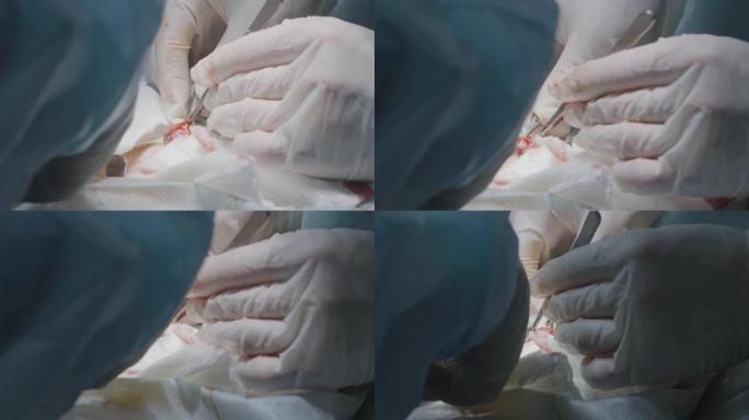 医生进行手术切除阑尾。行动。外科医生在麻醉下对人进行手术。肿瘤切除和器官手术