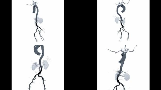 CTA全主动脉血管造影滤器视图旋转屏幕以诊断主动脉瘤。