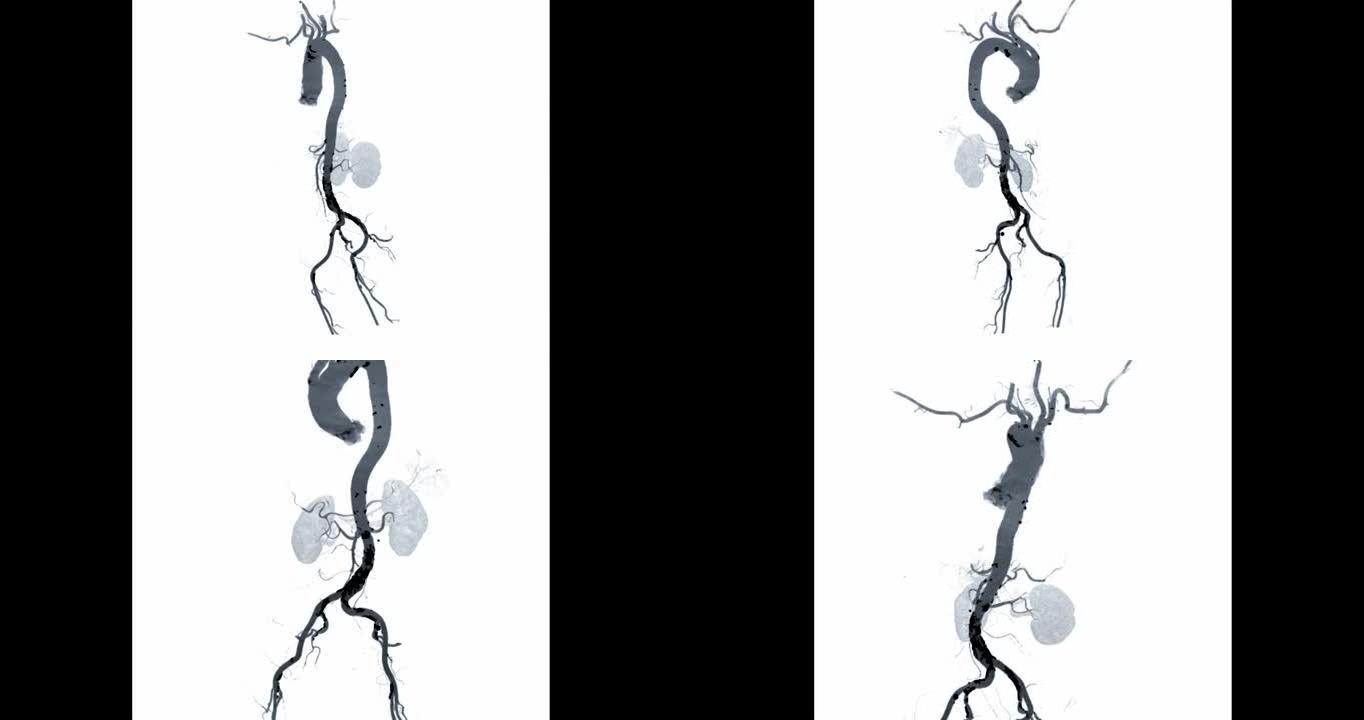 CTA全主动脉血管造影滤器视图旋转屏幕以诊断主动脉瘤。