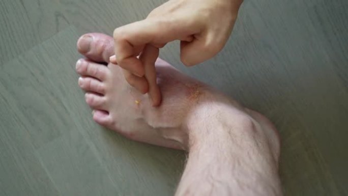腿上有许多蚊子叮咬。过敏反应，皮炎。女人的手在皮肤上涂抹药膏